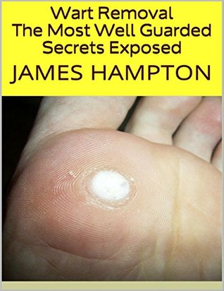Read Online Wart Removal: The Most Well Guarded Secrets Exposed - James Hampton | PDF